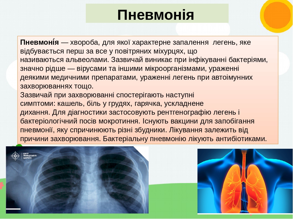 Пневмонія Пневмоні́я — хвороба, для якої характерне запалення легень, яке відбувається перш за все у повітряних міхурцях, що називаються альвеолами...