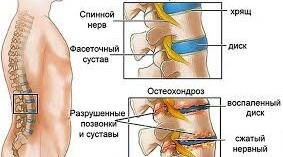 Презентація "Остеохондроз поперекового відділу"