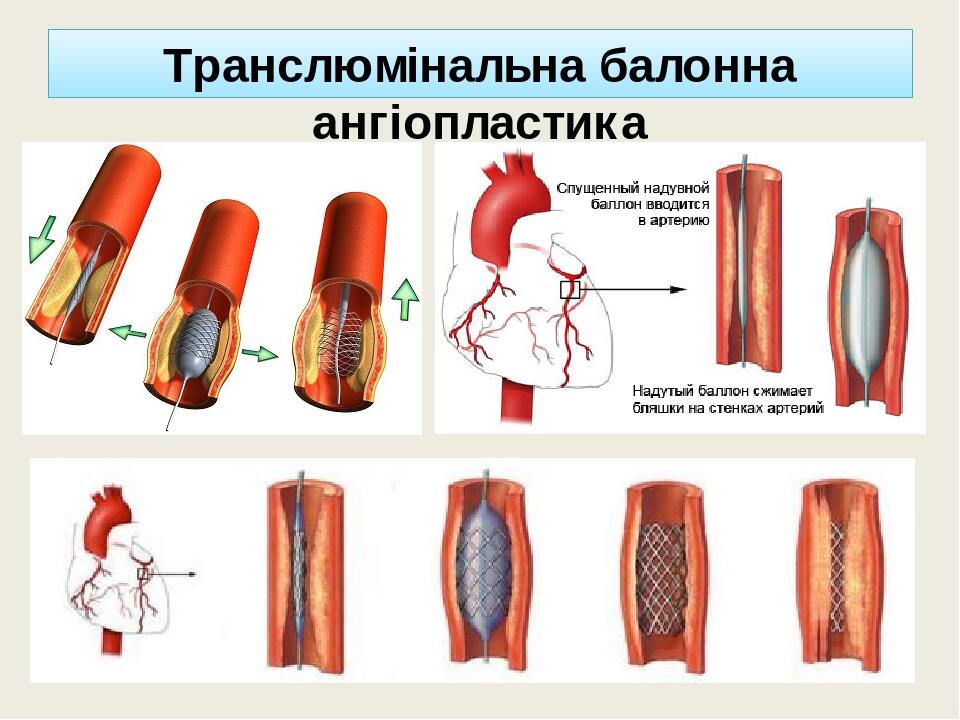 ІХС. Стенокардія. Інфаркт міокарда. | Презентація. внутрішня медицина