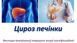 Презентація з внутрішньої медицини на тему: "Цироз печінки"
