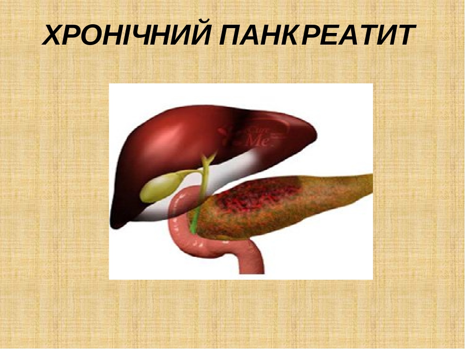 Панкреатит на фоне желчекаменной болезни