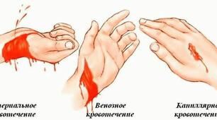 Хірургія. Кровотечі. Гемостаз