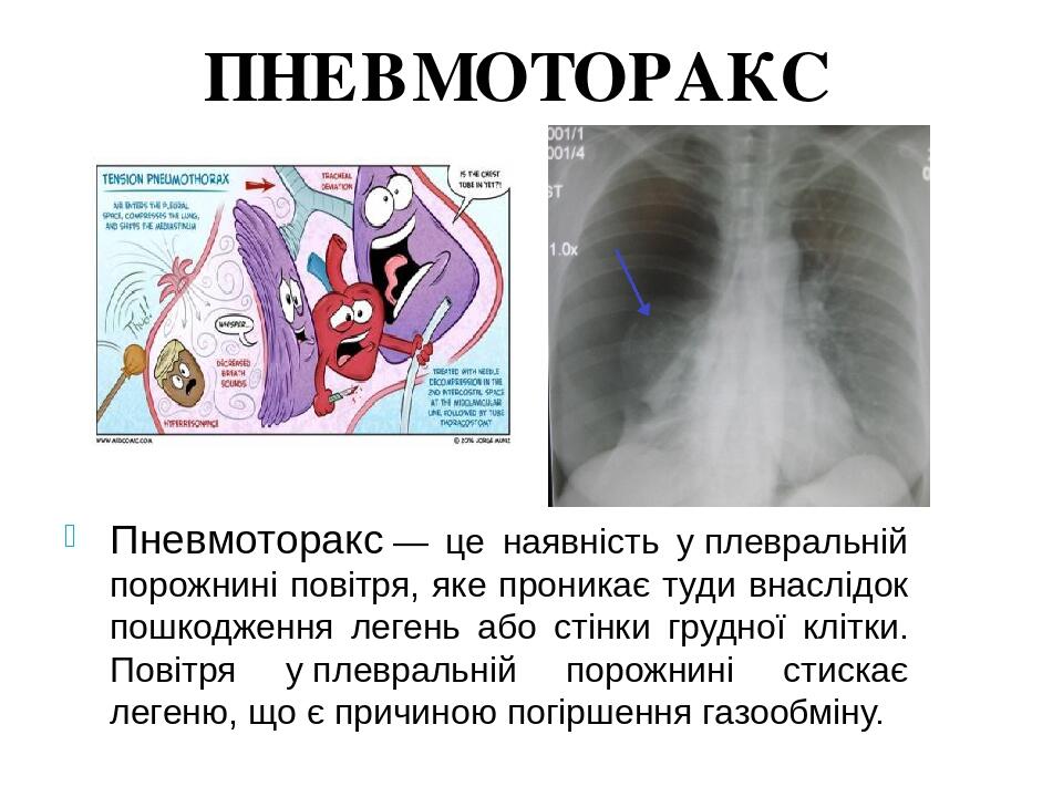 Пневмоторакс закрытый фото