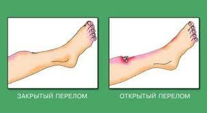 Що таке відкритий перелом, його види та ознаки