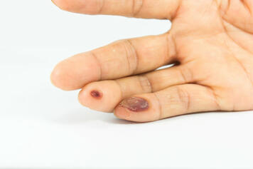 Premium Photo | Blisters on finger caused by electric shock