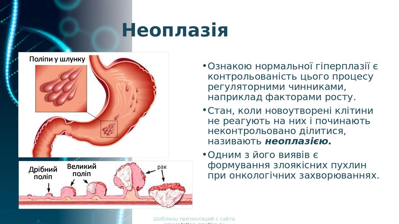 Неоплазія Ознакою нормальної гіперплазії є контрольованість цього процесу регуляторними чинниками, наприклад факторами росту. Стан, коли новоутворе...