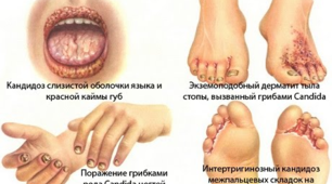 Грибкові захворювання шкіри