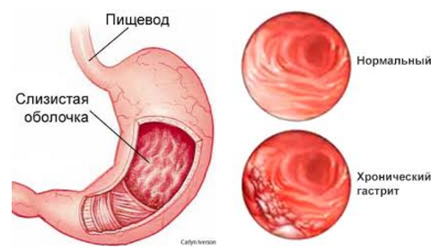 Картинки по запросу гастрит