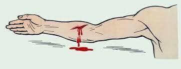 Венозна кровотеча: як швидко розпізнати і надати допомогу | Медичний довідник Virgo